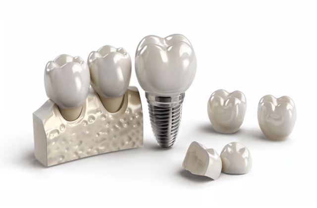 prix implant dentaire